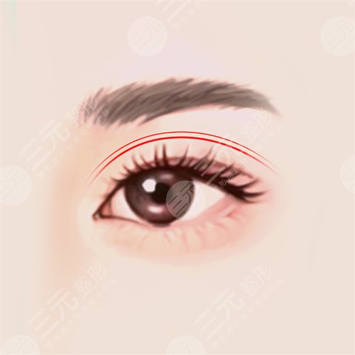 江蘇省中醫(yī)院雙眼皮術(shù)前