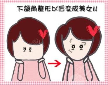 寬下頜角整形恢復(fù)