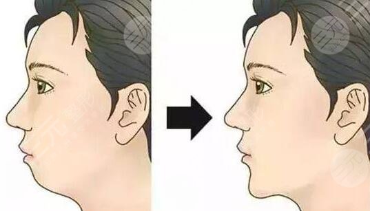 西京整形醫(yī)院假體墊下巴真實案例分享