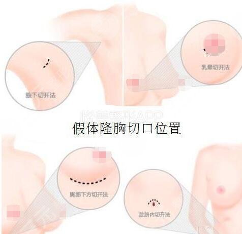 沈陽(yáng)杏林整形醫(yī)院豐胸案例分享