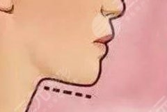 下頜緣吸脂后遺癥有哪些，危險(xiǎn)大嗎？科普帶你了解真相！