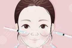 自體脂肪填充蘋果肌硬塊多久消？恢復(fù)過程全科普！