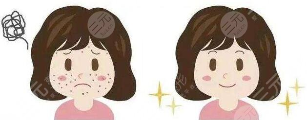 濟(jì)寧人民醫(yī)院激光祛痘祛疤圖