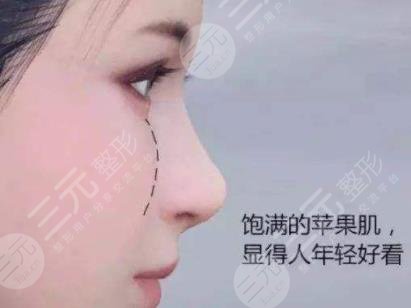 自體脂肪填充蘋果肌多久恢復(fù)自然