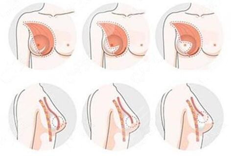 假體隆胸手術(shù)術(shù)前要準(zhǔn)備什么?