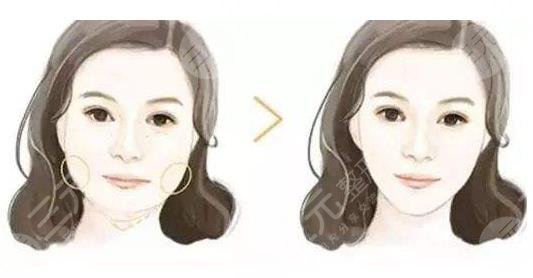 磨下頜角手術(shù)經(jīng)歷