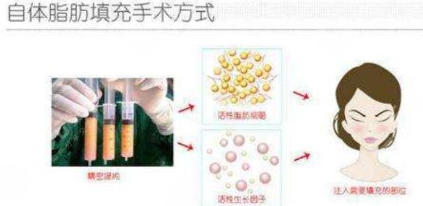 二次冷凍脂肪填充可靠嗎？自體脂肪填充技術(shù)原理_注意事項(xiàng)