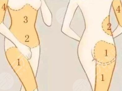 自體脂肪填充面頰多久可以側(cè)睡?