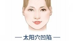 自體脂肪填充太陽凹陷多久恢復(fù)？科普分析優(yōu)點，塑顏小心機(jī)！