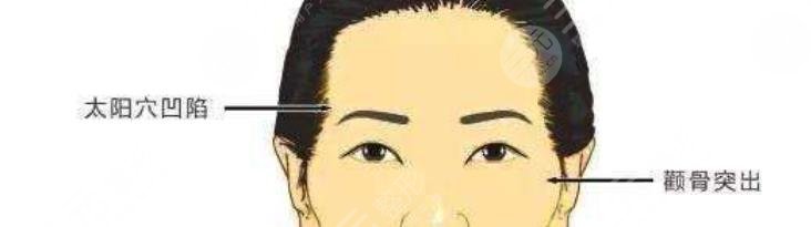 太陽(yáng)穴凹陷