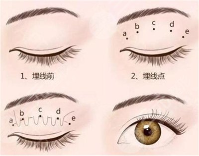 八大處雙眼皮價格表