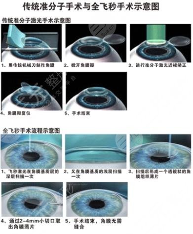 全飛秒近視矯正疼不疼