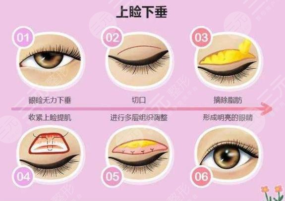 上瞼下垂去醫(yī)院還是整形醫(yī)院？科普講解手術(shù)原理，了解一下！