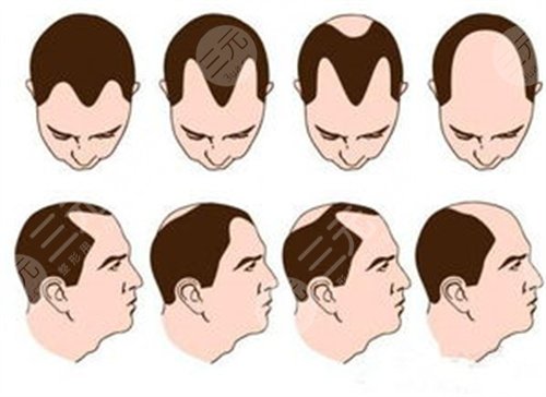 西京醫(yī)院植發(fā)價(jià)目表