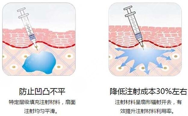 北京玻尿酸去除法令紋多少錢