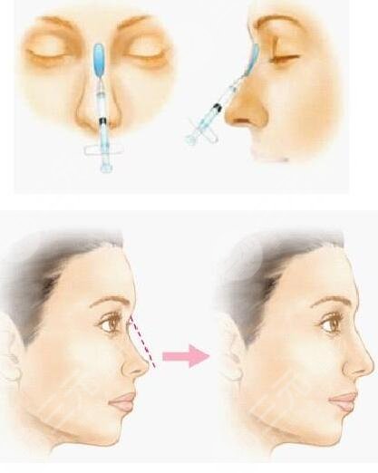 北京玻尿酸去除法令紋多少錢