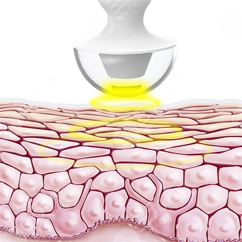 光子嫩膚后的一些注意事項(xiàng)