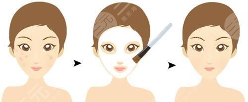 果酸換膚一次大概多少錢 果酸換膚果圖