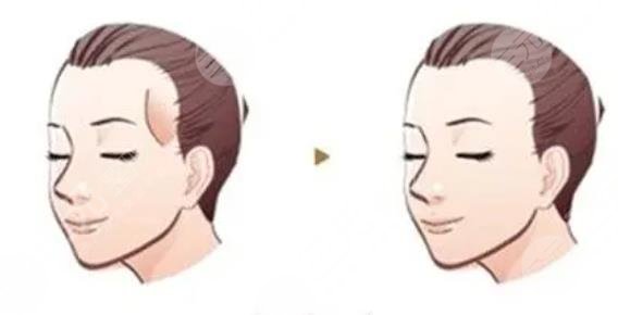 太陽(yáng)穴凹陷