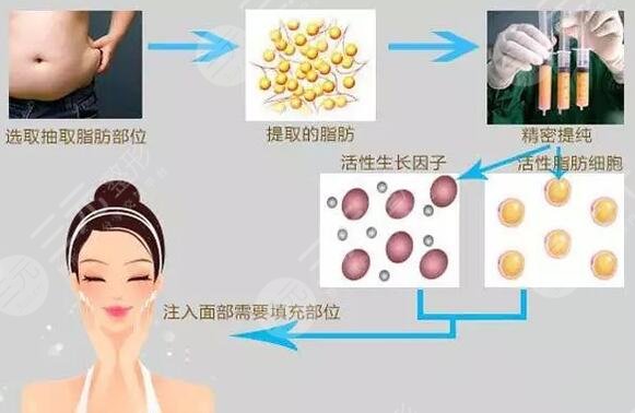 我的自體脂肪面部填充經(jīng)歷，持續(xù)中???