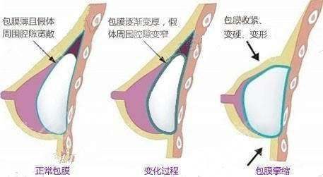 假體隆胸的注意事宜有哪些？