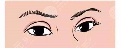 埋線(xiàn)雙眼皮