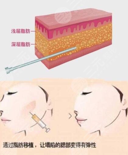 脂肪填充臉部有什么副作用？悄悄變身飽滿少女臉~