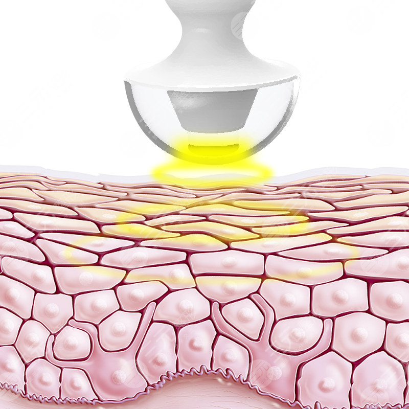 射頻緊膚和熱拉提的區(qū)別還沒搞清楚？別糾結(jié)了！看這篇全明白 ！