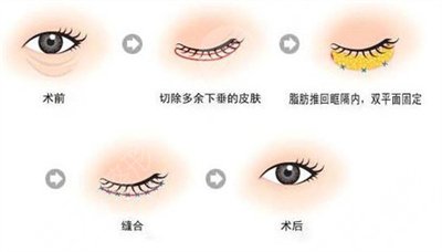 去眼袋手術(shù)果對(duì)比圖