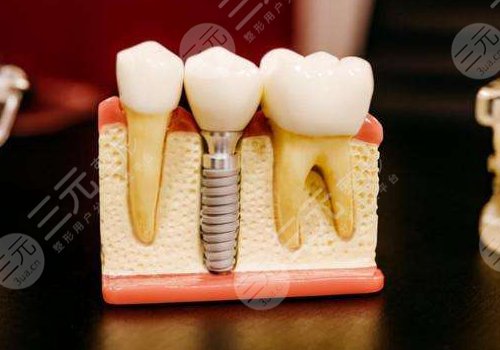 2022全國種植牙價格表種植牙的價格表，品牌、醫(yī)生、規(guī)模影響價格