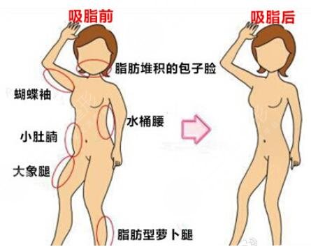 聚焦減脂超脂塑