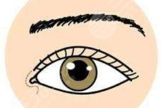 開內(nèi)眼角有增生怎么辦?開眼角增生期多久消失