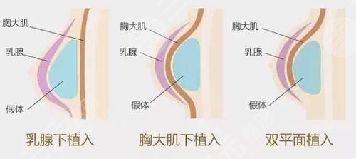 假體豐胸降低風(fēng)險嗎？術(shù)后注意事項有哪些