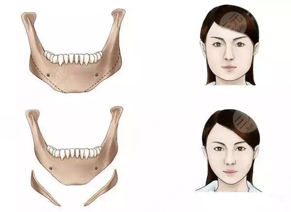 下頜角截骨手術(shù)恢復(fù)期？下頜角截骨多久能恢復(fù)