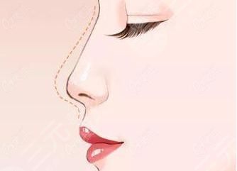 耳軟骨怎么墊鼻尖 耳軟骨墊鼻尖鼻尖會尖嗎