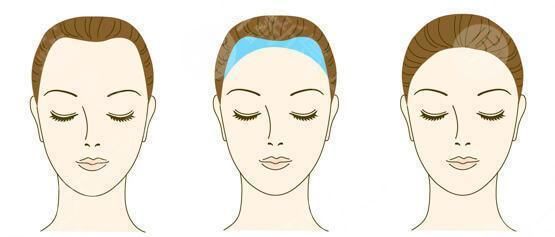 種植發(fā)際線要多久恢復(fù)?發(fā)際線種植注意事項?