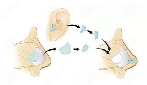 耳軟骨墊鼻尖失敗多久可以二次修復(fù)