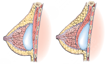 假體隆胸注意事項有哪些?假體隆胸手術(shù)過程圖片
