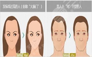 M型發(fā)際線植發(fā)多少錢? M型發(fā)際線植發(fā)費用貴嗎?