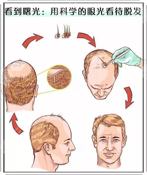 FUE植發(fā)多少錢?FUE植發(fā)的價格?