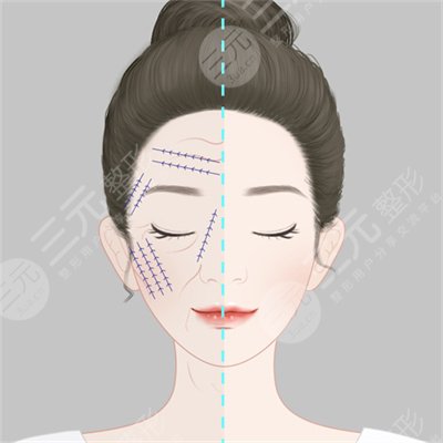 熱拉提有副作用嗎?