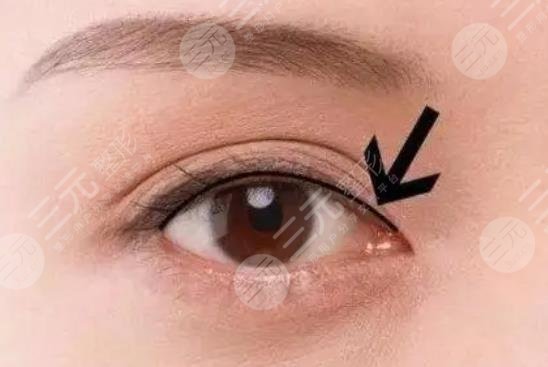 美瞳線一到七天恢復(fù)過(guò)程圖