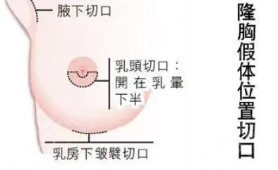 假體隆胸手術(shù)適合哪些人呢?