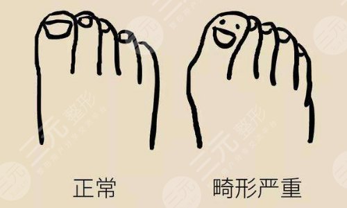 大腳骨外翻手術(shù)的診斷依據(jù)是什么?