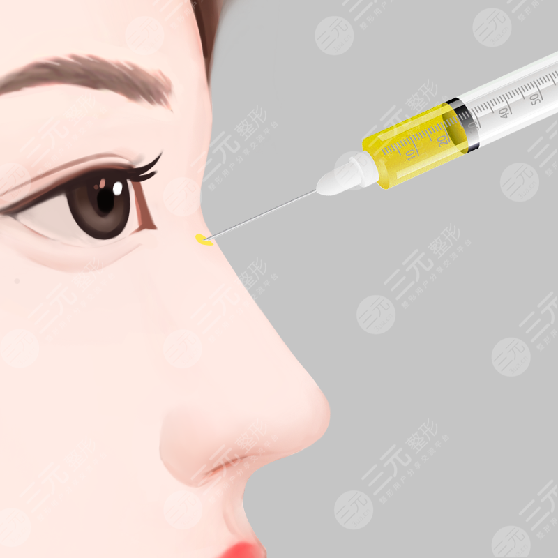 隆鼻失敗二次修復果怎么樣，多少錢