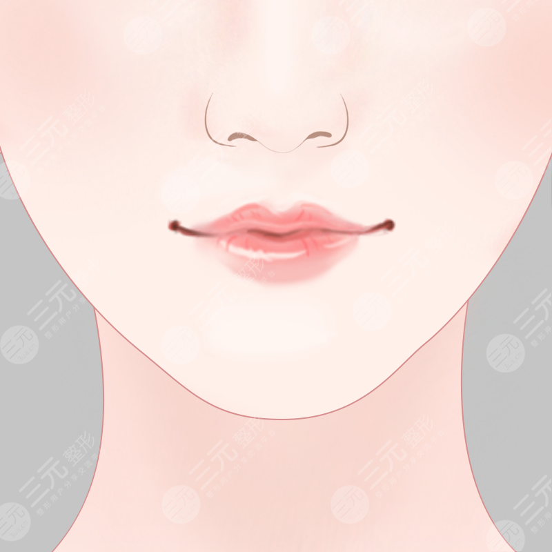 自體脂肪豐唇術后多久能恢復?