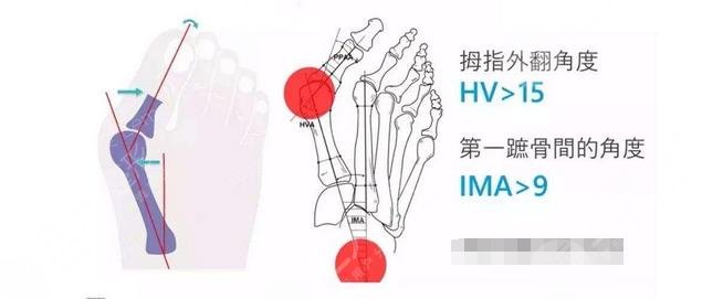 高跟鞋姐妹必看|大腳骨外翻怎么樣緩解？診斷依據(jù)+術(shù)后注意事項(xiàng)盤點(diǎn)！