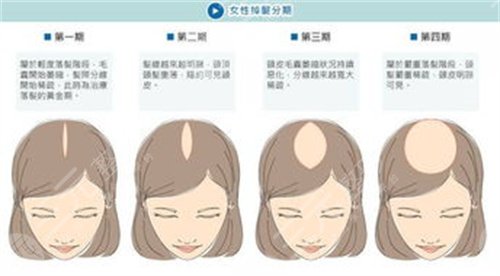 上海劍橋醫(yī)院植發(fā)怎么樣?植發(fā)醫(yī)生名單&植發(fā)案例果對比圖~