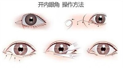 割雙眼皮開眼角有什么好處