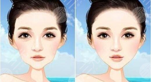 自體脂肪豐下巴果好不好，一次多少錢